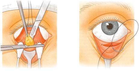 去眼袋必知：去眼袋的四种经典手术方法